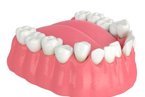 Illustration of crowded teeth in lower dental arch