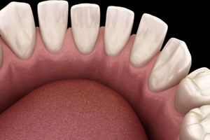 Illustration of teeth with gaps between them